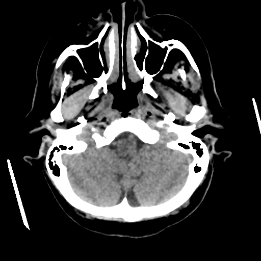 Cerebral metastasis to basal ganglia (Radiopaedia 81568-95412 Axial non-contrast 15).png