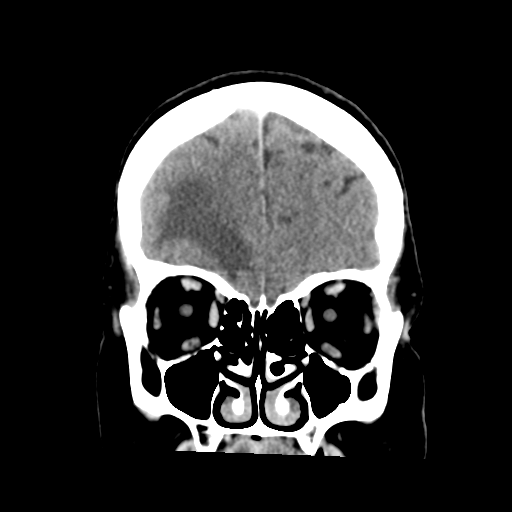 Cerebral metastasis to basal ganglia (Radiopaedia 81568-95412 Coronal C+ delayed 15).png