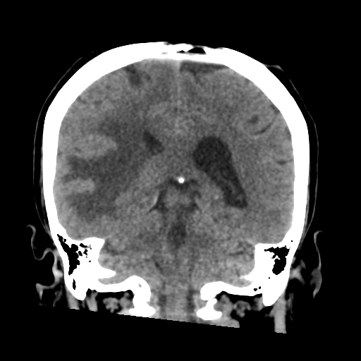 Cerebral metastasis to basal ganglia (Radiopaedia 81568-95412 Coronal non-contrast 44).png