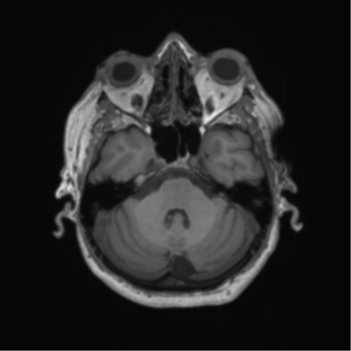 File:Cerebral metastasis to basal ganglia (Radiopaedia 81568-95413 Axial T1 17).png