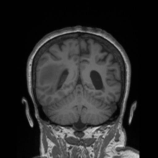 Cerebral metastasis to basal ganglia (Radiopaedia 81568-95413 Coronal T1 9).png