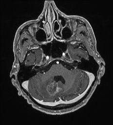 Cerebral toxoplasmosis (Radiopaedia 43956-47461 Axial T1 C+ 16).jpg