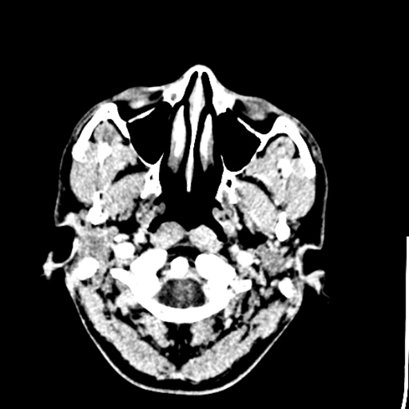 File:Cerebral toxoplasmosis (Radiopaedia 53993-60131 Axial C+ delayed 4).jpg