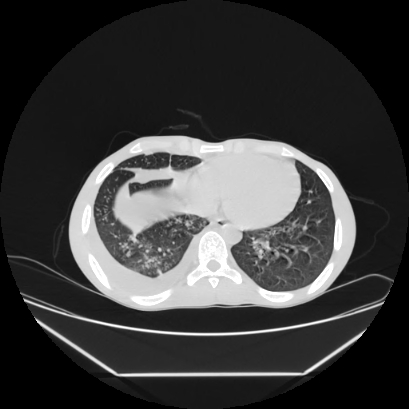 Cerebral tuberculoma (Radiopaedia 80829-94318 Axial lung window 134).jpg