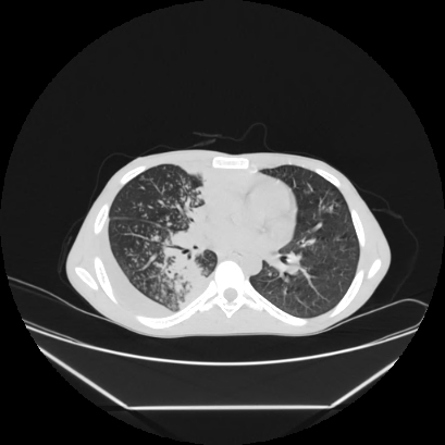 File:Cerebral tuberculoma (Radiopaedia 80829-94318 Axial lung window 91).jpg