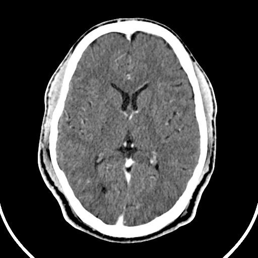 File:Cerebral venous angioma (Radiopaedia 69959-79977 B 49).jpg