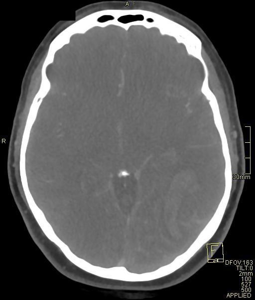 Cerebral venous sinus thrombosis (Radiopaedia 91329-108965 Axial venogram 39).jpg