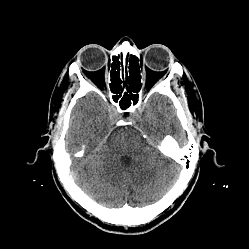 File:Cerebral venous thrombosis (CVT) (Radiopaedia 77524-89685 Axial non-contrast 14).jpg