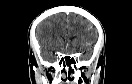 Cerebral venous thrombosis (CVT) (Radiopaedia 77524-89685 C 21).jpg
