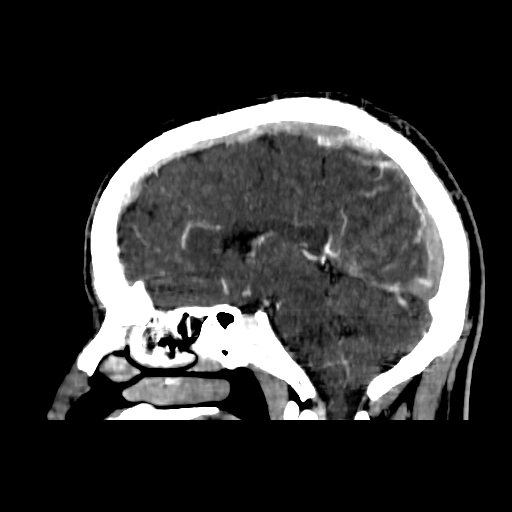 File:Cerebral venous thrombosis (CVT) (Radiopaedia 77524-89685 Sagittal CTV 20).jpg