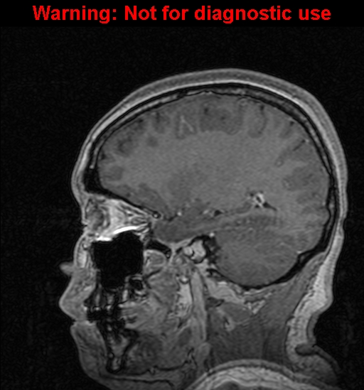 Cerebral venous thrombosis (Radiopaedia 37224-39208 Sagittal T1 C+ 54).jpg