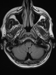 File:Cerebral venous thrombosis (Radiopaedia 38392-40469 Axial FLAIR 4).png