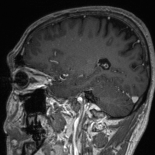 File:Cerebral venous thrombosis (Radiopaedia 38392-40469 Sagittal T1 C+ 32).png