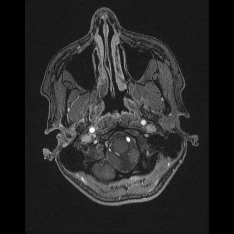 Cerebral venous thrombosis (Radiopaedia 45678-49854 Axial MRV 2).jpg