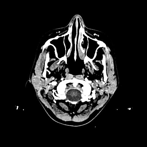 Cerebral venous thrombosis with venous hemorrhagic infarct (Radiopaedia 90354-107660 Axial with contrast 5).jpg