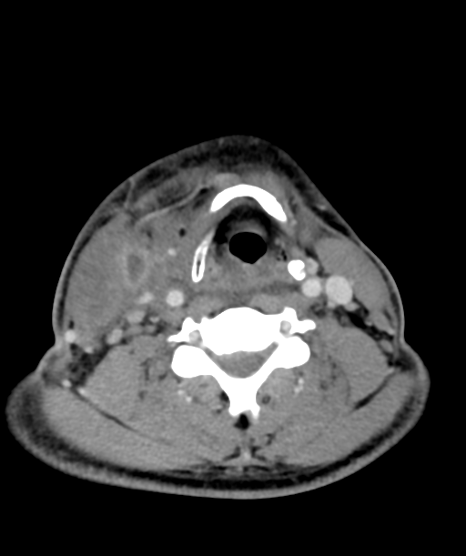 Cervical abscess (Radiopaedia 43725-47184 A 41).png