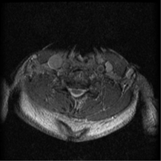 Cervical canal stenosis with cord compression (Radiopaedia 34114-35374 Axial Gradient Echo 35).png