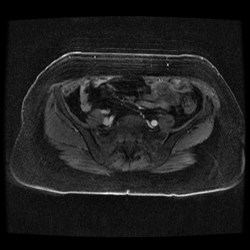 Cervical carcinoma (Radiopaedia 70924-81132 Axial T1 C+ fat sat 162).jpg