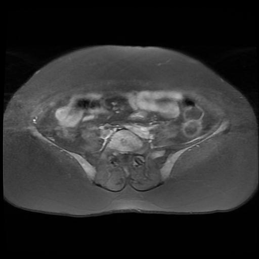 File:Cervical carcinoma (Radiopaedia 88010-104555 Axial T1 C+ fat sat 1).jpg