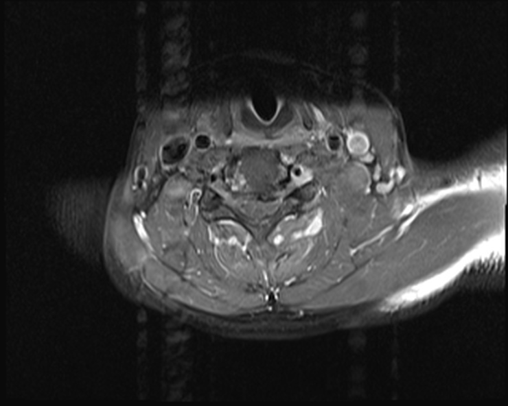 File:Cervical disc extrusion (Radiopaedia 53950-60077 Axial T1 C+ fat sat 16).jpg