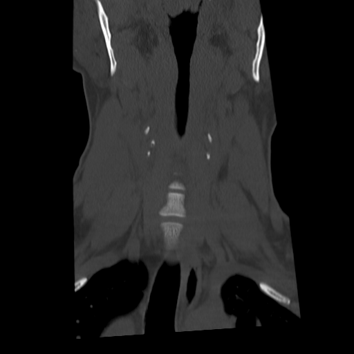 Cervical schwannoma (Radiopaedia 57979-64974 Coronal bone window 20).png