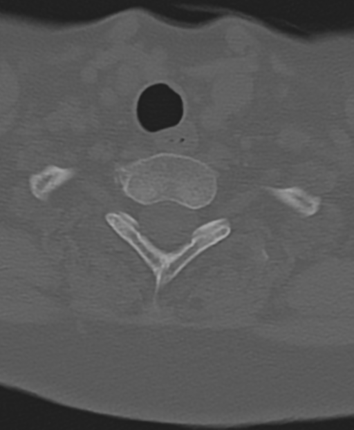 Cervical spine ACDF loosening (Radiopaedia 48998-54071 Axial bone window 51).png
