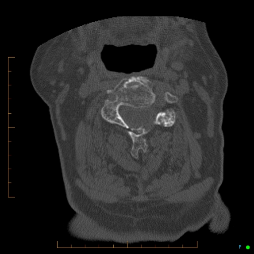 File:Cervical spine fracture - ankylosing spondylitis (Radiopaedia 76835-88706 Axial bone window 87).jpg