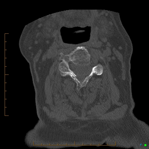 Cervical spine fracture - ankylosing spondylitis (Radiopaedia 76835-88706 Axial bone window 92).jpg
