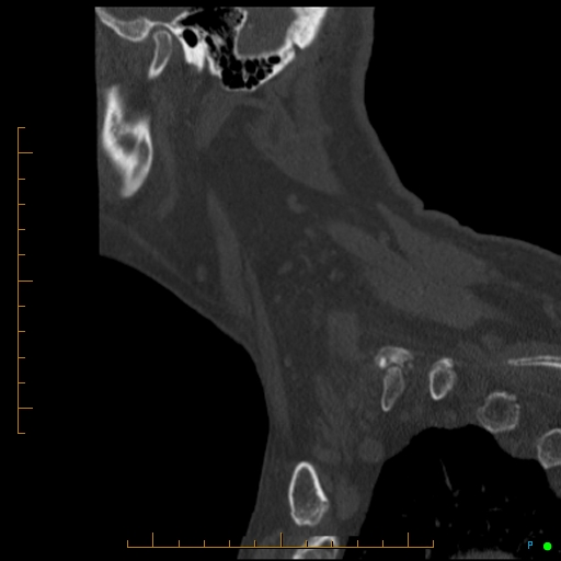 Cervical spine fracture - ankylosing spondylitis (Radiopaedia 76835-88706 Sagittal bone window 14).jpg
