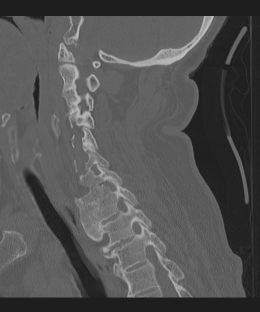 Cervical spine fracture in the setting of ankylosis (Radiopaedia 37038-38715 Sagittal bone window 48).png