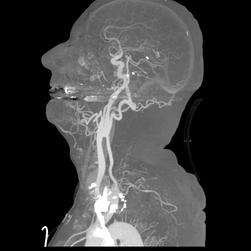 File:Cervical spine fractures with vertebral artery dissection (Radiopaedia 53296-59269 3D MIP 18).png