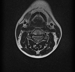 File:Cervical spondylodiscitis and calvarial hemangioma (Radiopaedia 64317-73104 Axial T2 6).jpg
