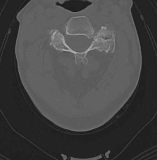 Cervical spondylolysis (Radiopaedia 49616-54811 Axial bone window 24).png