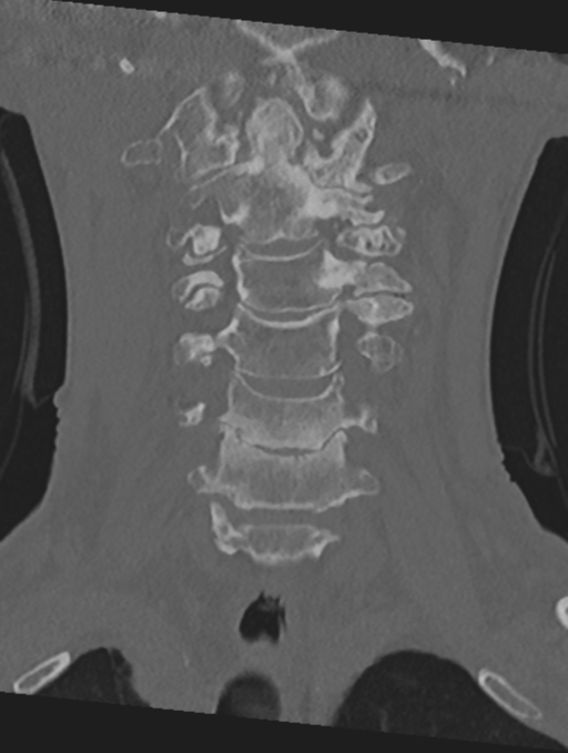 Cervical spondylolysis (Radiopaedia 49616-54811 Coronal bone window 17).png