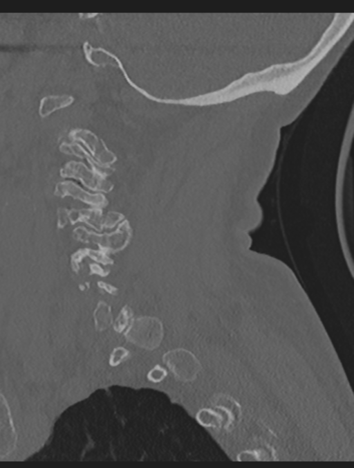 Cervical spondylolysis (Radiopaedia 49616-54811 Sagittal bone window 19).png