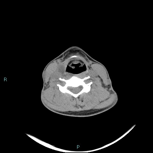 Cervical thymic cyst (Radiopaedia 88632-105335 Axial non-contrast 56).jpg