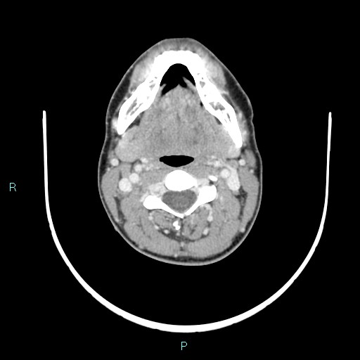 Cervical thymic cyst (Radiopaedia 88632-105335 C 76).jpg