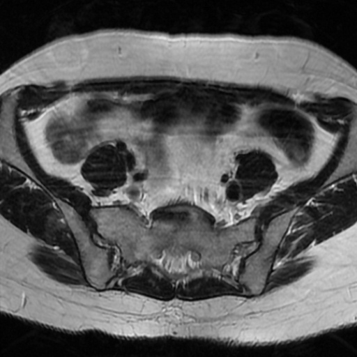 File:Cesarian section scar endometriosis (Radiopaedia 66520-75799 Axial T2 1).jpg