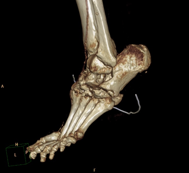 File:Charcot joint (Radiopaedia 36629-38194 3D bone window 10).jpg