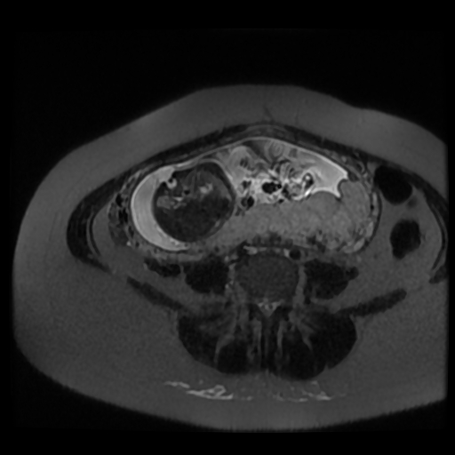 Chiari II malformation - fetal MRI (Radiopaedia 68099-77581 Axial T2-SSFSE 21).jpg