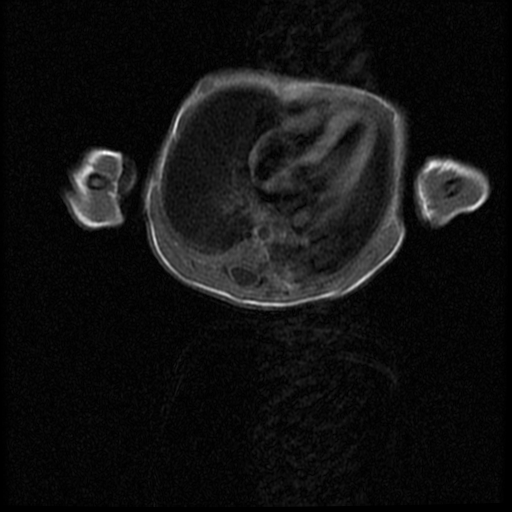 File:Chiari II malformation with spinal meningomyelocele (Radiopaedia 23550-23652 Axial T1 5).jpg