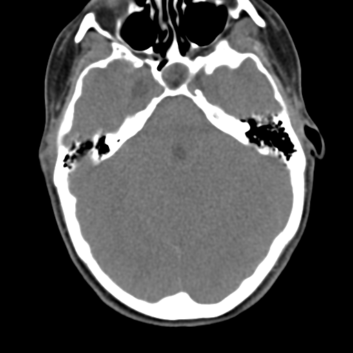 File:Chiari I malformation and obstructive hydrocephalus (Radiopaedia 41185-43981 D 20).png