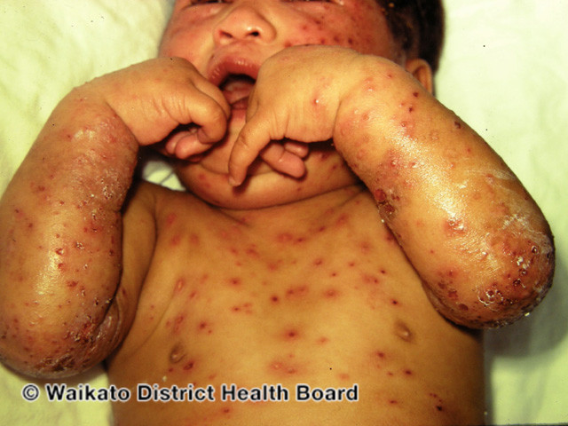File:Chickenpox (DermNet NZ viral-w-varicella121).jpg