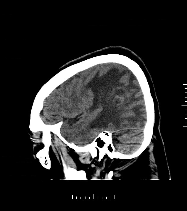 Cholangiocarcinoma with cerebral metastases (Radiopaedia 83519-98628 C 10).jpg