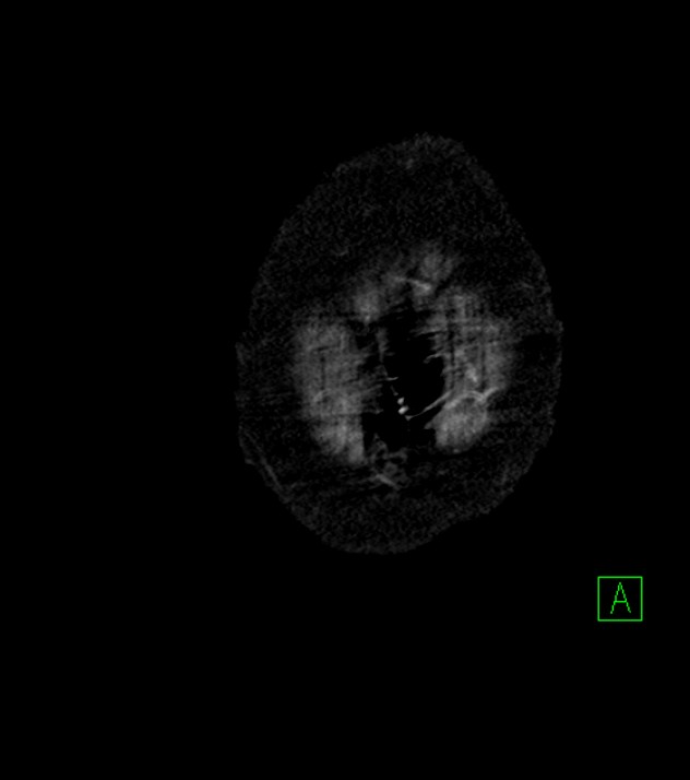 Cholangiocarcinoma with cerebral metastases (Radiopaedia 83519-98629 E 1).jpg