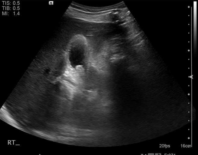File:Cholecystitis - perforated gallbladder (Radiopaedia 57038-63913 A 27).jpg