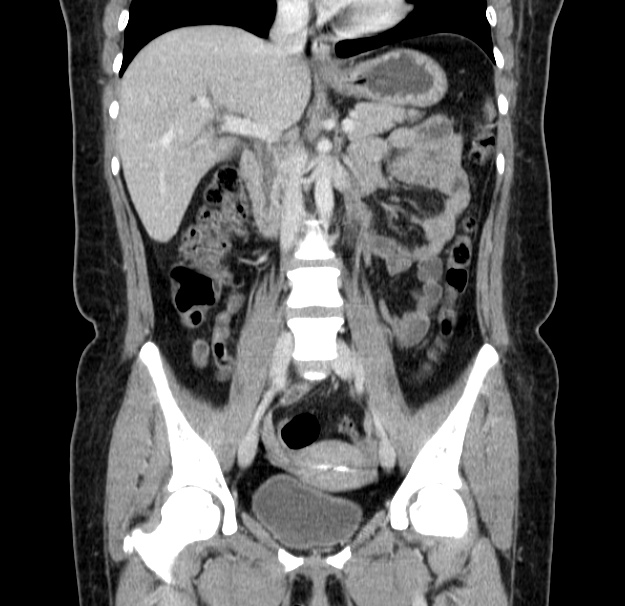 Choledocholithiasis on CT and MRI (Radiopaedia 24825-25087 C 25).jpg
