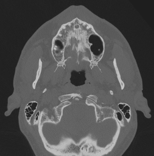 Chondrosarcoma (clivus) (Radiopaedia 46895-51425 Axial bone window 75).png