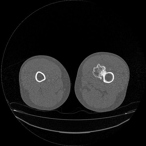 File:Chondrosarcoma arising from exostosis (Radiopaedia 59996-67507 Axial bone window 13).jpg