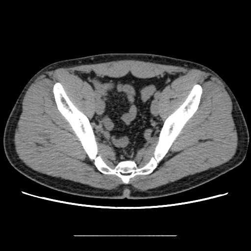 Chondrosarcoma of iliac wing (Radiopaedia 63861-72599 Axial non-contrast 76).jpg